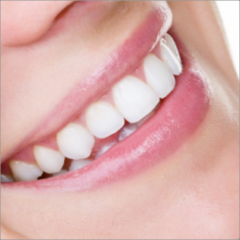 Sorriso com facetas dentárias