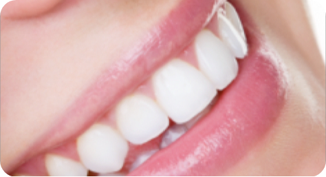 Colocação das facetas definitivas