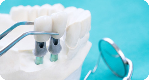 Prótese total sobre implante
